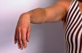 آسیب عصب رادیال(نوروپاتی رادیال)یا افتادگی مچ دست(Wrist drop)