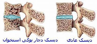 درمان پوکی استخوان یا استئوپورز: