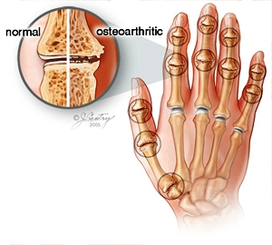 درمان آرتروز دست(کف دست و انگشتان):